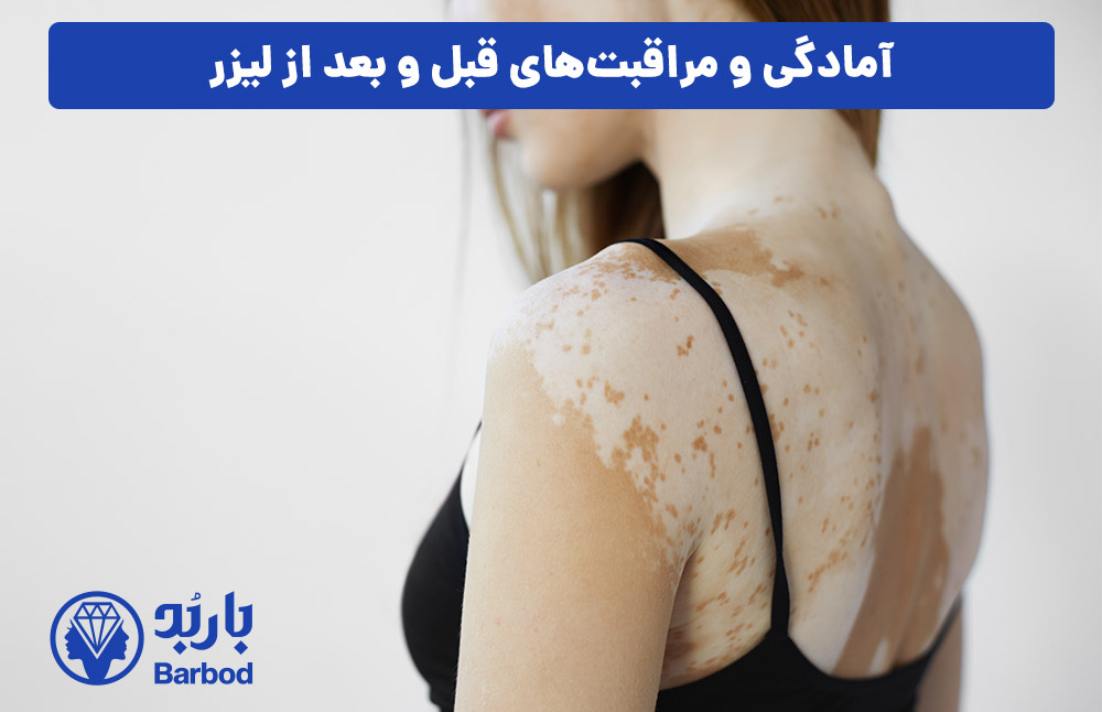 آمادگی و مراقبت‌های قبل و بعد از لیزر