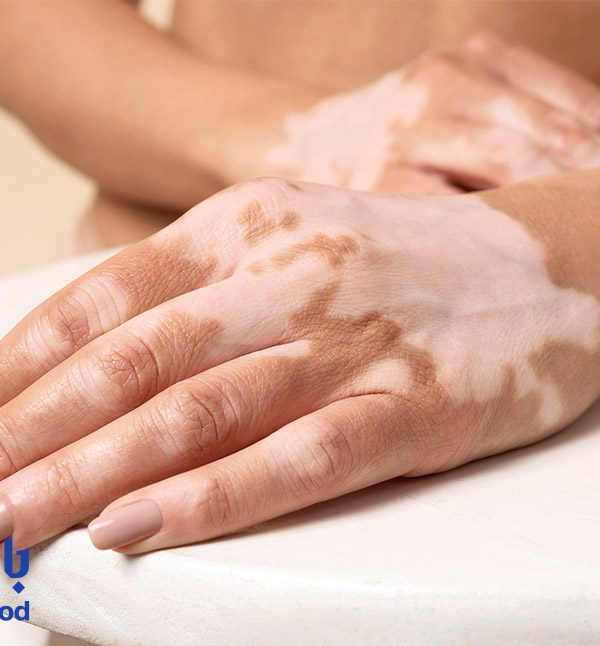 آیا لیزر موهای زائد برای افراد ویتیلیگو توصیه می شود ؟