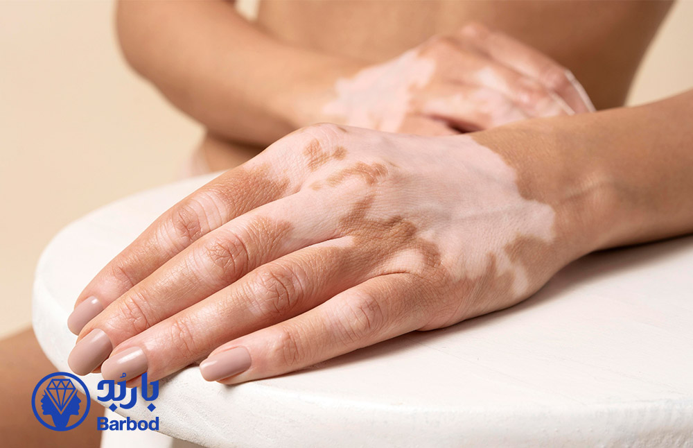 آیا لیزر موهای زائد برای افراد ویتیلیگو توصیه می شود ؟