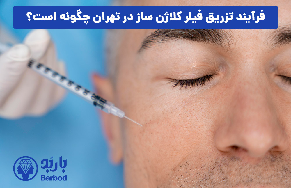 فرآیند تزریق فیلر کلاژن ساز در تهران چگونه است؟