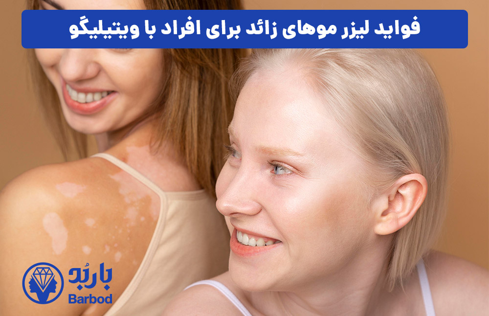 فواید لیزر موهای زائد برای افراد با ویتیلیگو