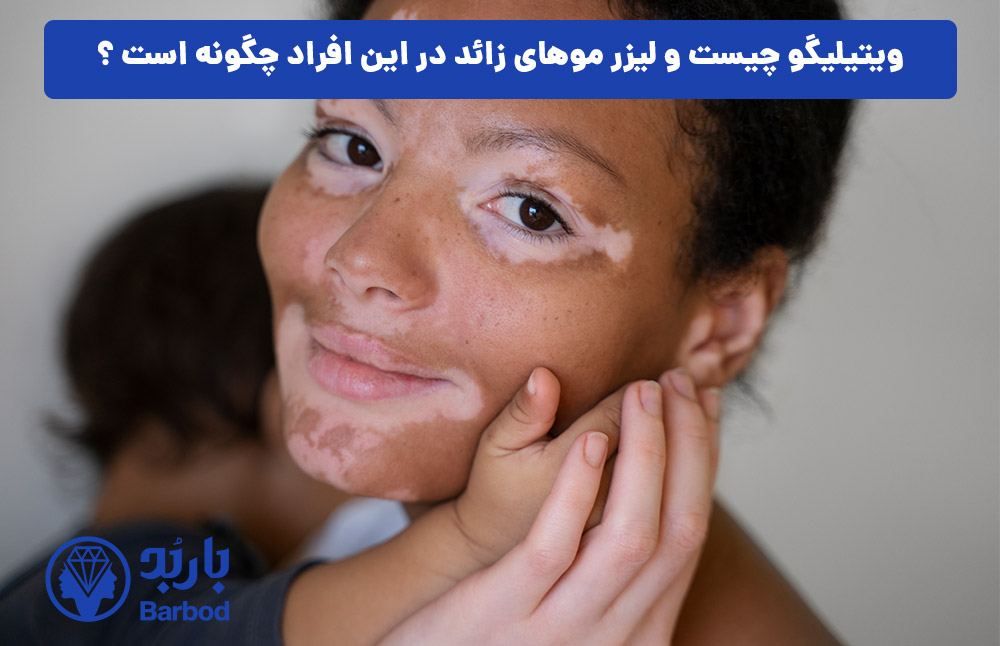 ویتیلیگو چیست و لیزر موهای زائد در این افراد چگونه است ؟