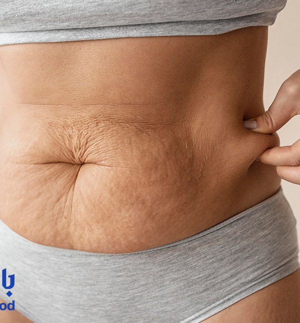 فیلر برای شلی شکم پس از زایمان در تهران