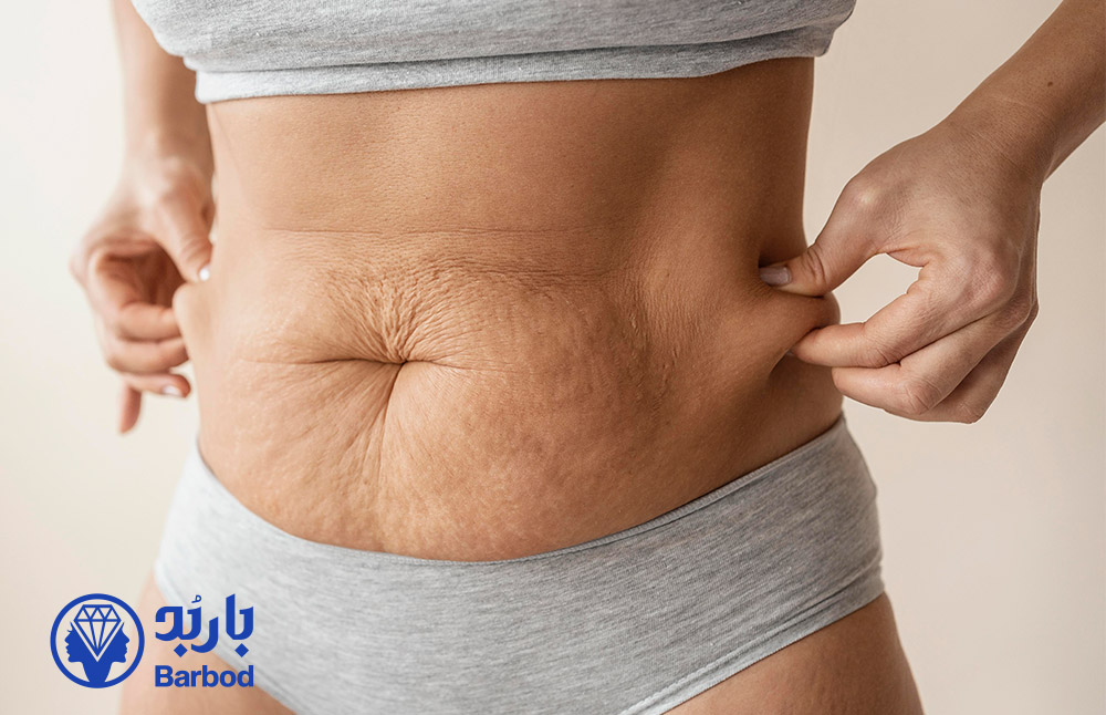 فیلر برای شلی شکم پس از زایمان در تهران
