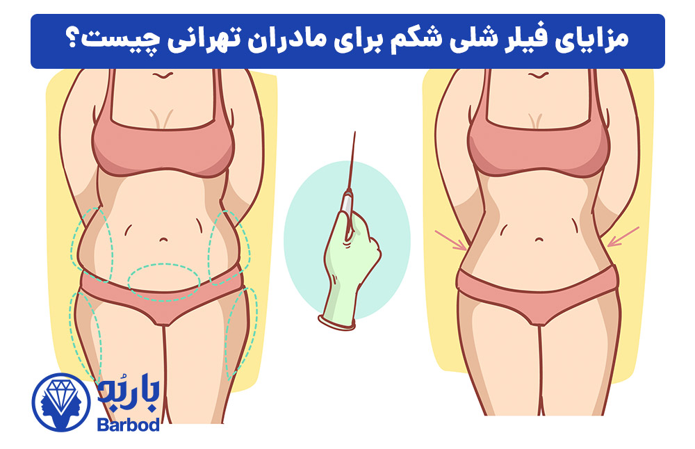 مزایای فیلر شلی شکم برای مادران تهرانی چیست؟