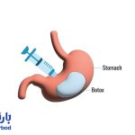 چرا بعد از بوتاکس معده نباید قلیان و سیگار کشید ؟
