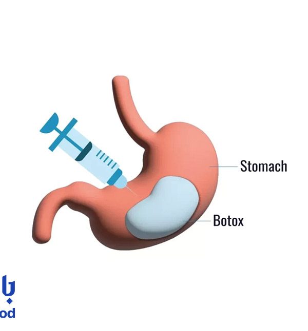چرا بعد از بوتاکس معده نباید قلیان و سیگار کشید ؟