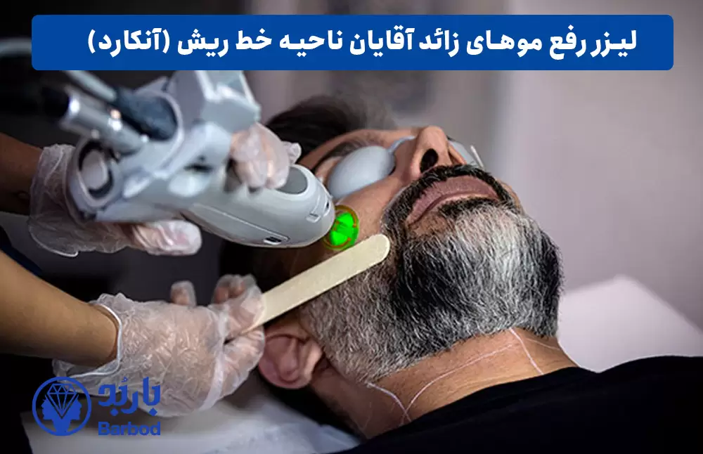 لیزر رفع موهای زائد اقایان ناحیه خط ریش