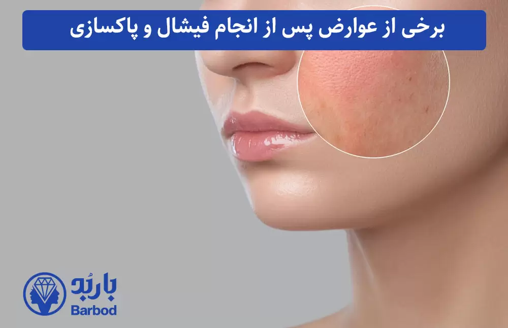 برخی از عوارض پس از انجام فیشال و پاکسازی