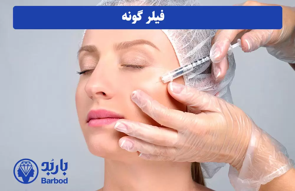 فیلر-گونه
