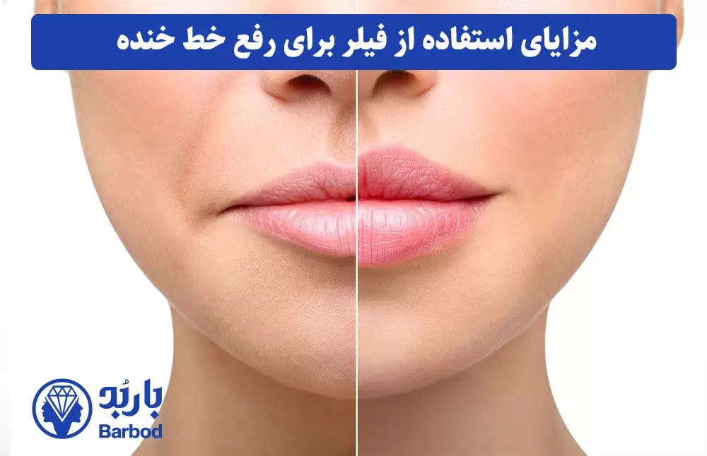 مزایای-استفاده-از-فیلر-برای-رفع-خط-خنده