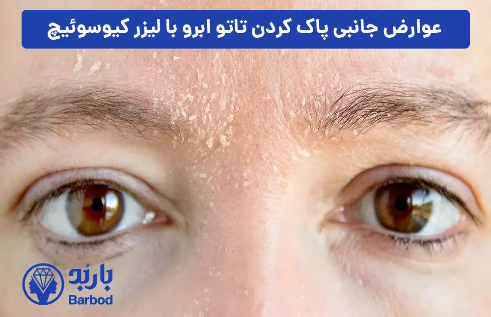 عوارض-جانبی-پاک-کردن-تاتو-ابرو-با-لیزر-کیوسوئیچ