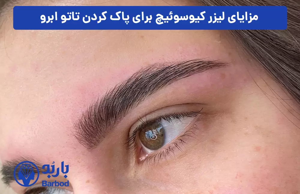 مزایای-لیزر-کیوسوئیچ-برای-پاک-کردن-تاتو-ابرو