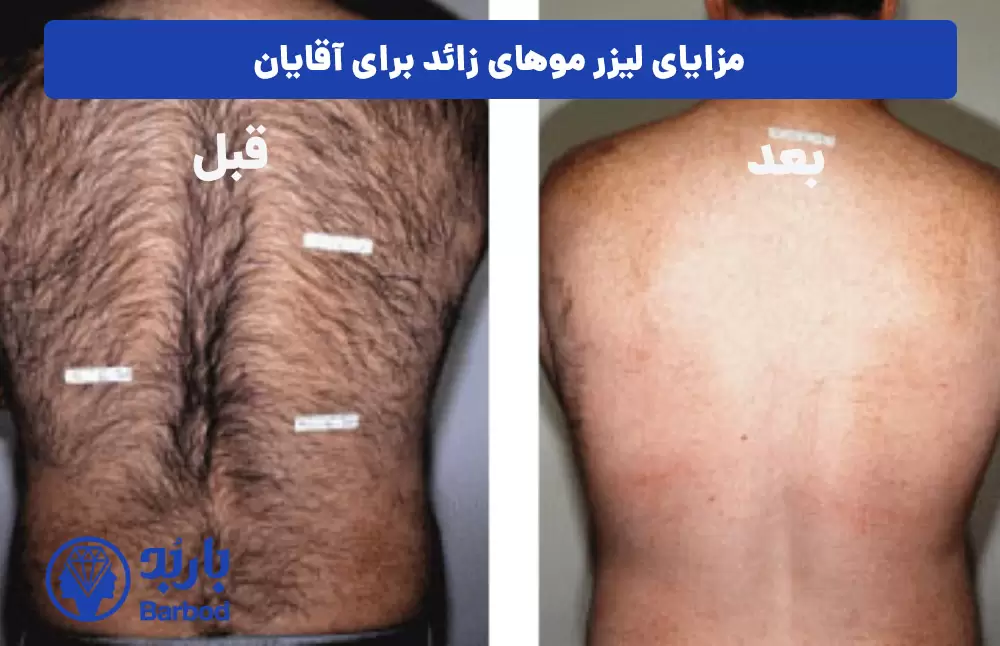 قبل و بعد لیزر آقایان